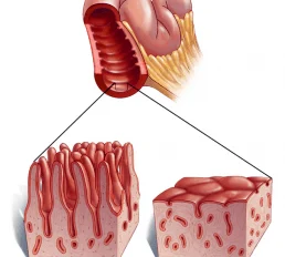 Diagram showing a comparison between a normal gut with healthy villi and a celiac disease gut with flattened, damaged villi.