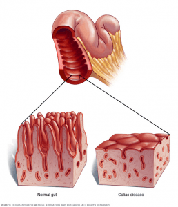 Diagram showing a comparison between a normal gut with healthy villi and a celiac disease gut with flattened, damaged villi.