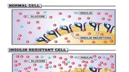 Diagram comparing a normal cell and an insulin resistant cell, showing reduced insulin receptor activity and less glucose uptake in the insulin resistant cell.